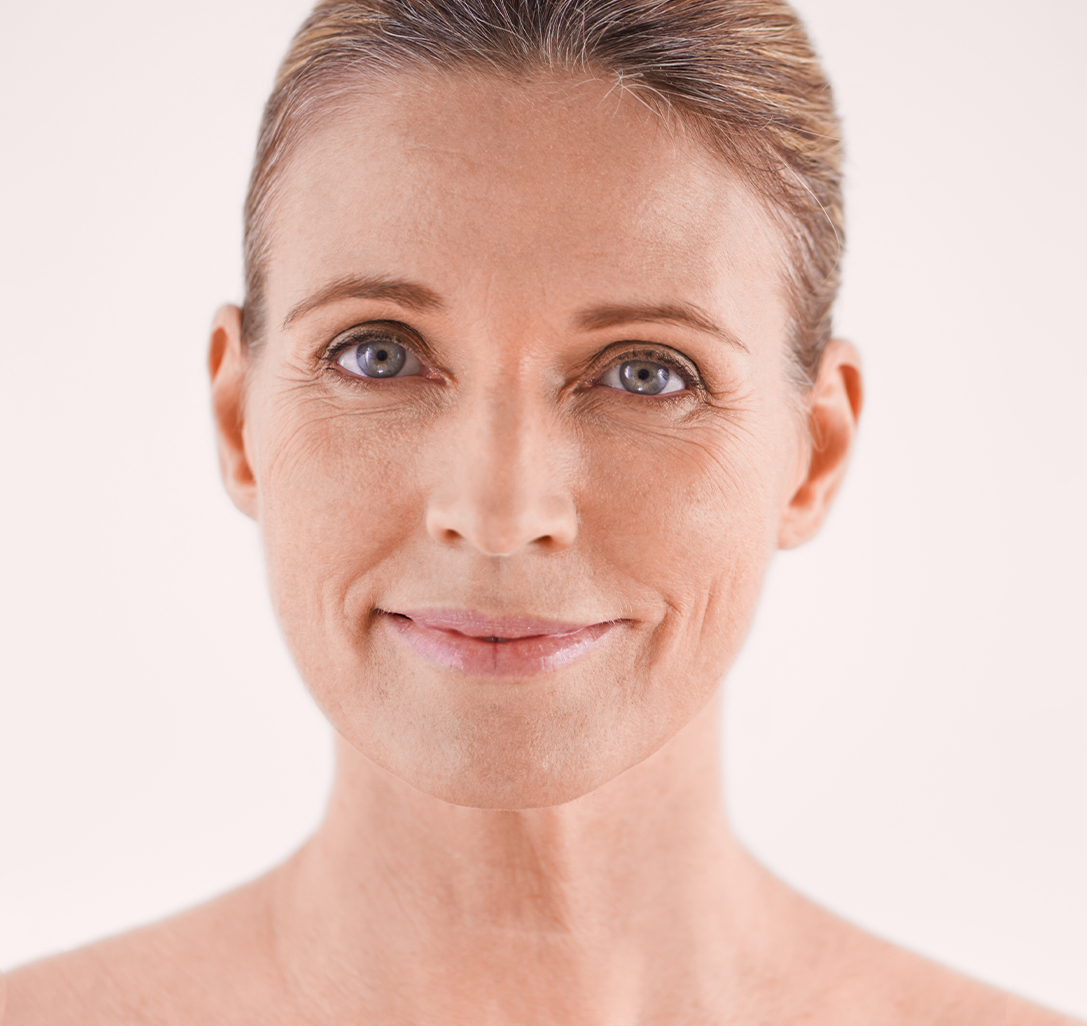 Lassità e Cedimento Moderato, Grado 4