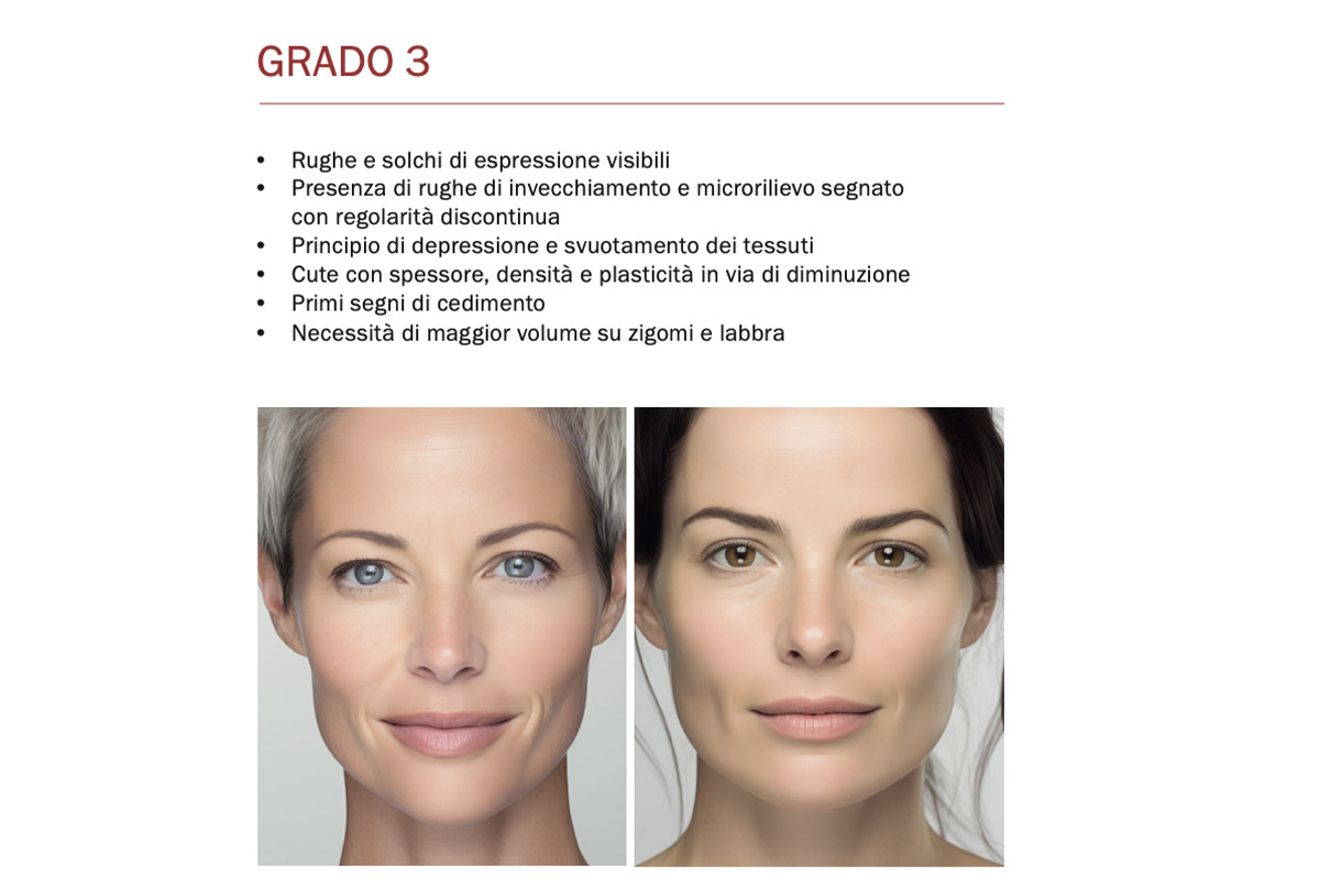 Fillerina – Fillerimetro Grado 3