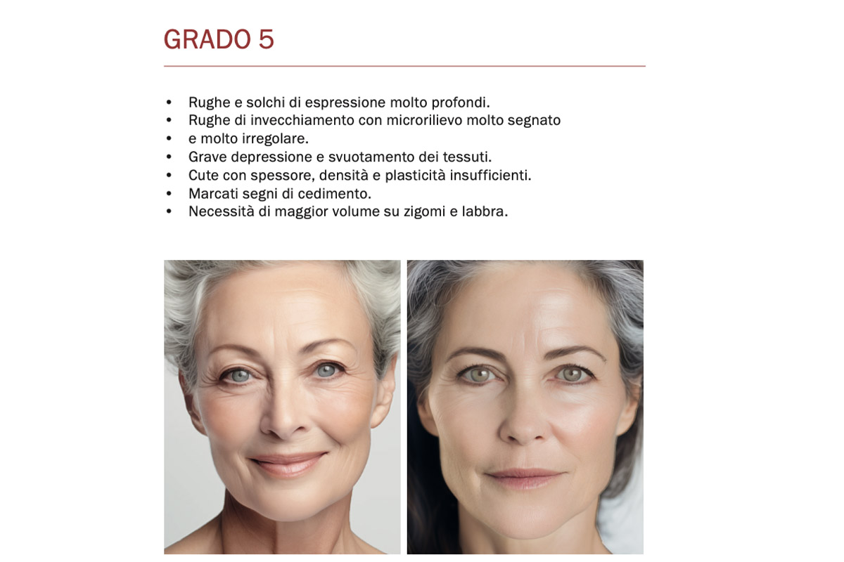 Fillerina – Fillerimetro Grado 5