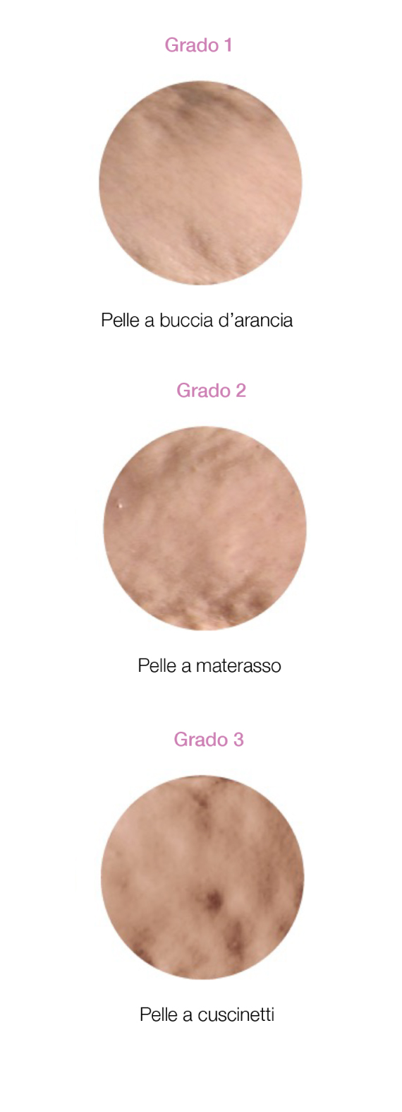 gradi-cellulite-verticale