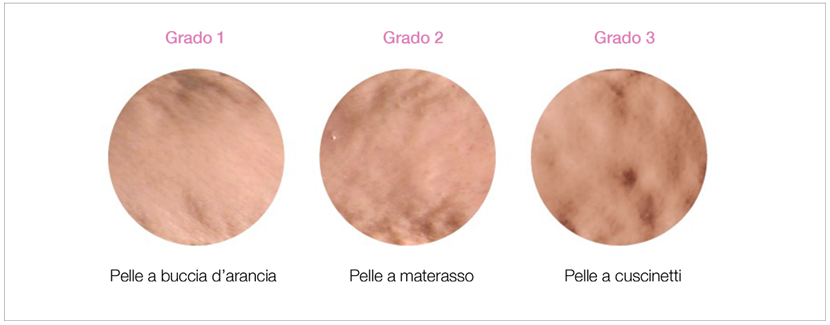 Gradi-cellulite