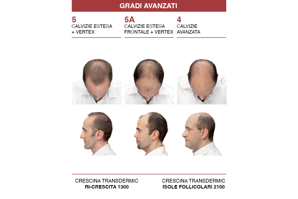 Crescina Diradometro – grado avanzato