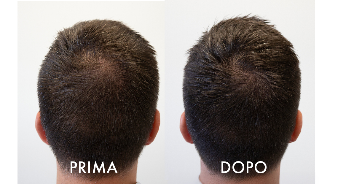 Crescina Fiale – risultati anti-diradamento dopo 2 mesi di trattamento