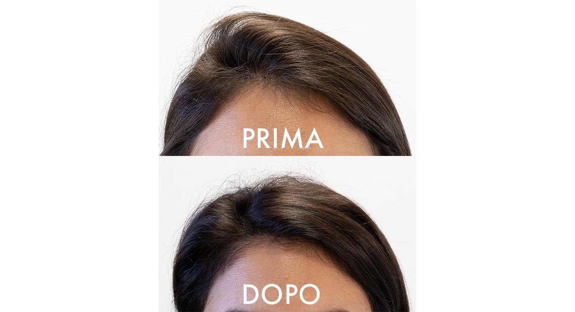 Crescina Fiale – risultati su diradamento temporale dopo 2 mesi di trattamento