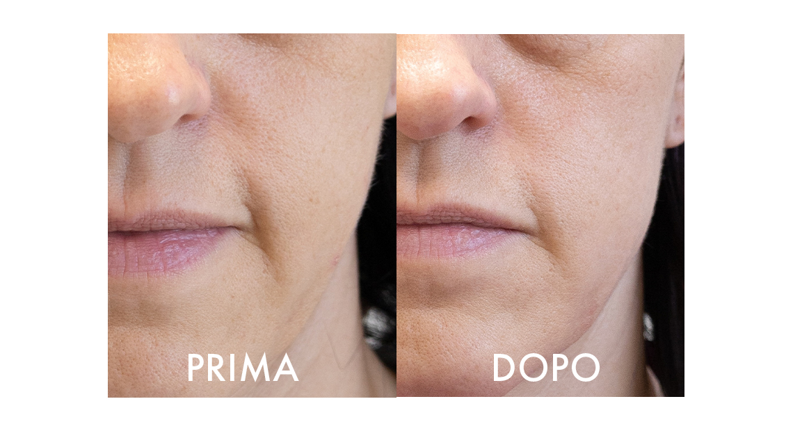 Collagenina Serum – riduzione rughe e pelle più tonica dopo 2 mesi