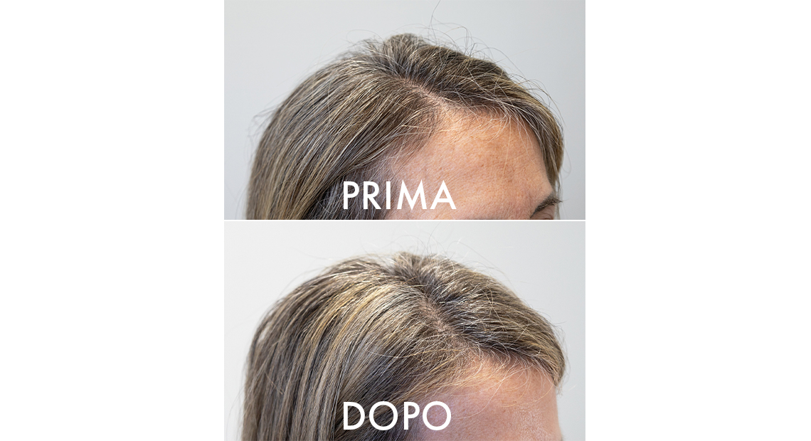 Crescina Lozione – mantenimento densità capelli dopo trattamento