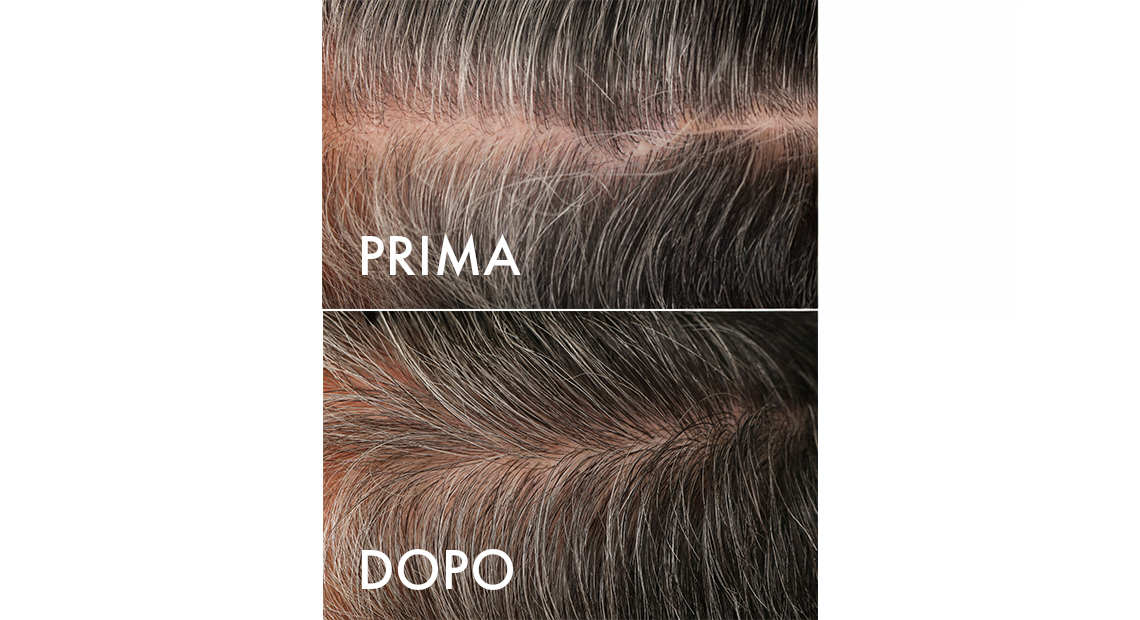 Capelli Bianchi – Risultati del trattamento su volontario 6