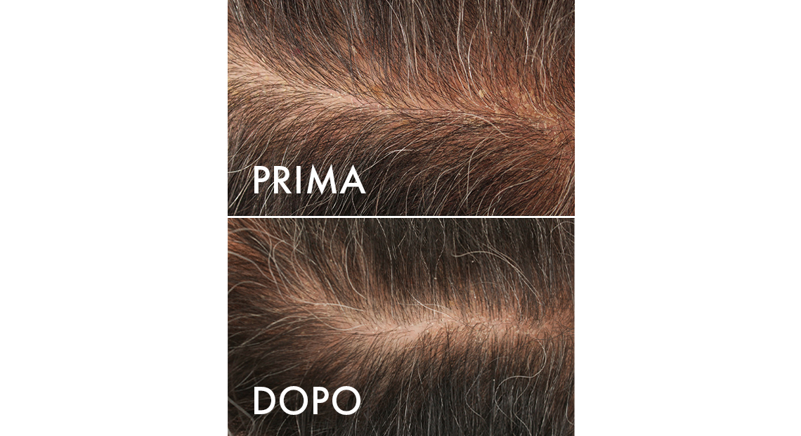 Capelli Bianchi – Risultati del trattamento su volontario 7