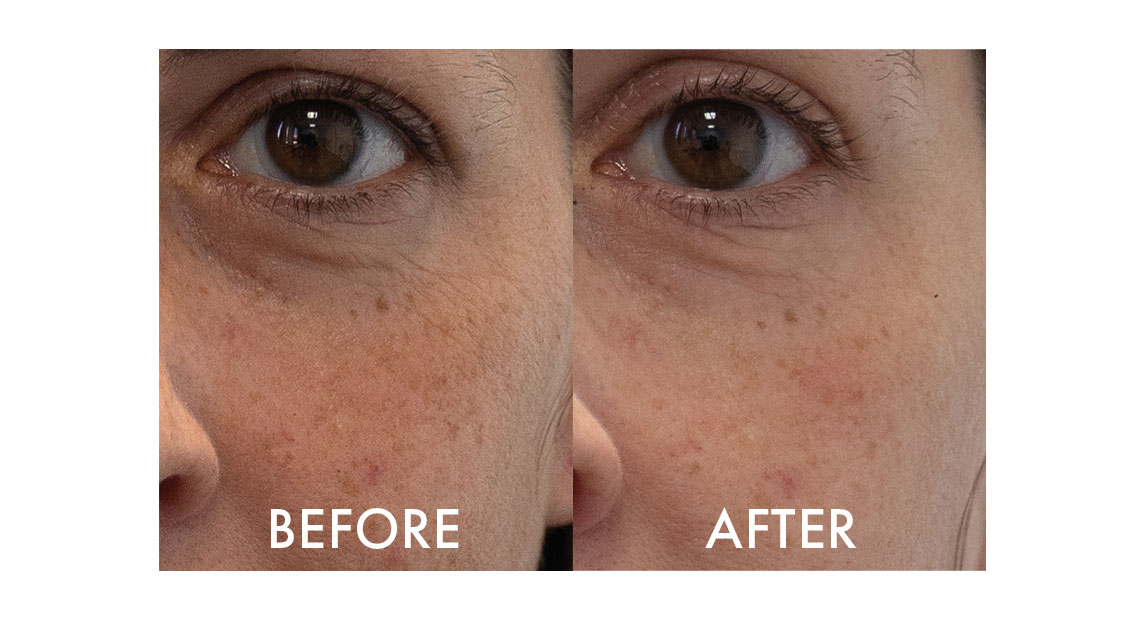 Collagenina Serum – Before & After Eye Contour Results