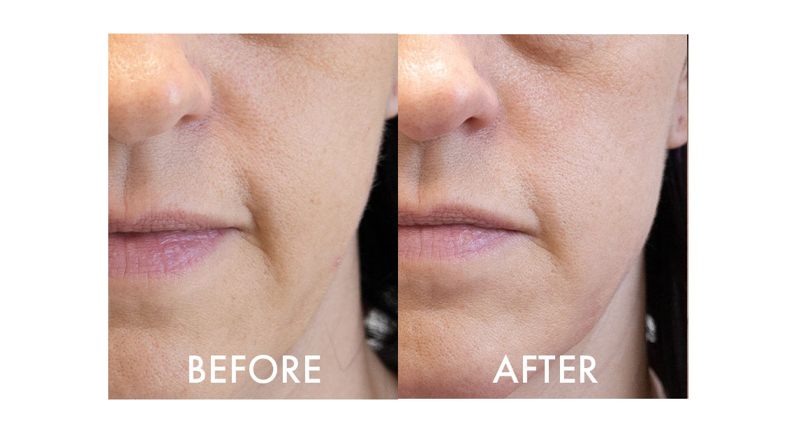 Collagenina Serum – Before & After Facial Firmness Results