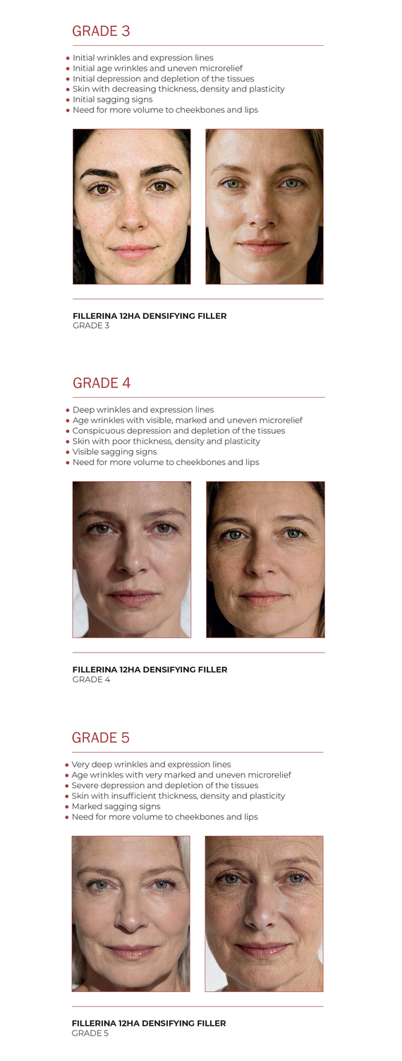 fillerina-12ha-densifying-filler-dosage-guide-grades-3-4-5-ok
